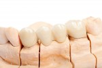 Teeth rehabilitation